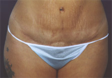 woman's abdomen after Abdominoplasty, front view