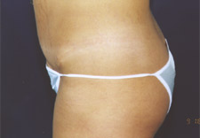 woman's abdomen after Abdominoplasty, left side