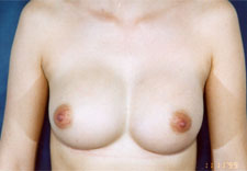 woman's breasts after Breast Augmentation, front view