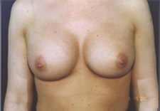 woman's breasts after Breast Augmentation, front view