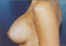 woman's breasts after Breast Augmentation, left side