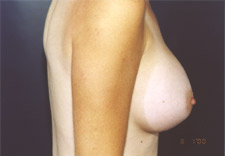 woman's breasts after Breast Augmentation, right side