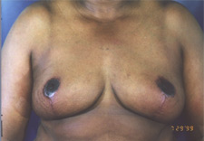 woman's breasts after Breast Reduction, front view