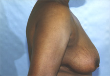 woman's breasts before Breast Reduction, right side