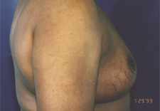woman's breasts after Breast Reduction, right side