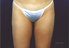 woman's lower body after Liposuction, front view
