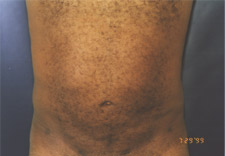 man's abdomen after Liposuction, front view