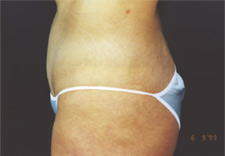 woman's lower body after Liposuction, left side