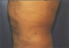 man's abdomen after Liposuction, left side