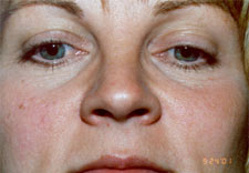 woman's nose after Rhinoplasty, front view