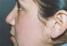 woman's nose after Rhinoplasty, left side