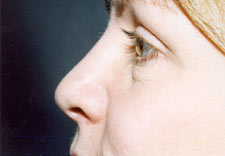 woman's nose after Rhinoplasty, left side