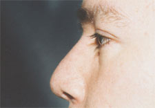 man's nose after Rhinoplasty, left side