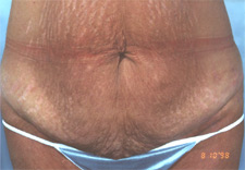 woman's abdomen before Abdominoplasty, front view