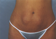 woman's abdomen before Abdominoplasty, front view