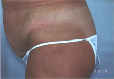 woman's abdomen before Abdominoplasty, left side