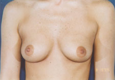 woman's breasts before Breast Augmentation, front view