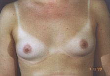 woman's breasts before Breast Augmentation, front view