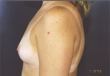 woman's breasts before Breast Augmentation, left side