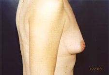 woman's breasts before Breast Augmentation, right side