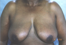 woman's breasts before Breast Reduction, front view