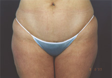 woman's lower body before Liposuction, front view