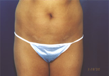 woman's lower body before Liposuction, front view