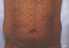 man's abdomen before Liposuction, front view