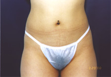 woman's lower body after Liposuction, front view