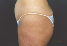 woman's lower body before Liposuction, left side