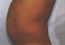 man's abdomen before Liposuction, left side