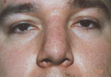 man's nose before Rhinoplasty, front view