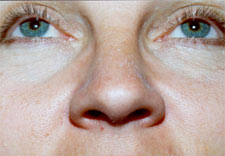 woman's nose before Rhinoplasty, front view