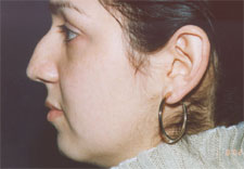 woman's nose before Rhinoplasty, left side