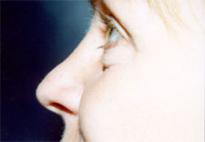 woman's nose before Rhinoplasty, left side