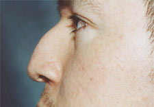 man's nose before Rhinoplasty, left side
